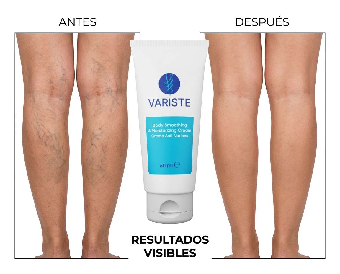 crema para varices piernas variste