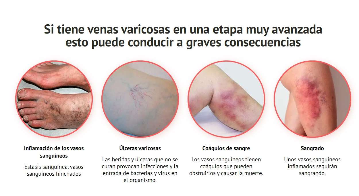 varices en piernas consecuencias venas varicosas